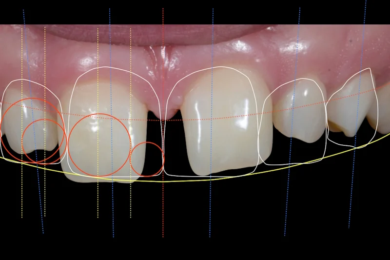 Diseño digital de la sonrisa